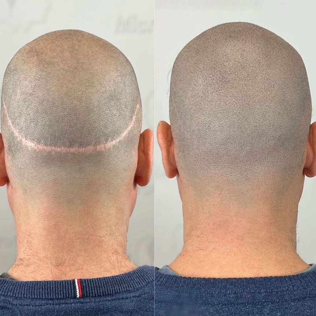 micropigmentacion capilar granada eliminador de tatuajes